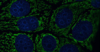 mitochondria in tumor cells